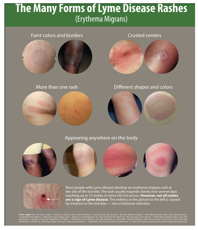 Image showing bullseye rashes